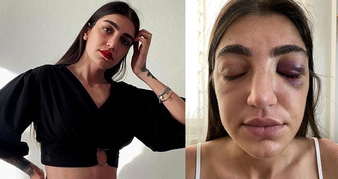 Genç mankene eski sevgili dehşeti!.. Acımasızca darp edildi